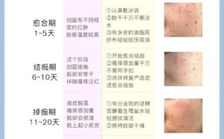 祛斑最有效的方法是什么_祛斑后会不会反弹