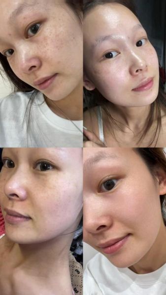 祛斑最有效的方法是什么_祛斑后会不会反弹-第3张图片-俊逸知识馆 祛斑最有效的方法是什么_祛斑后会不会反弹-第3张图片-俊逸知识馆