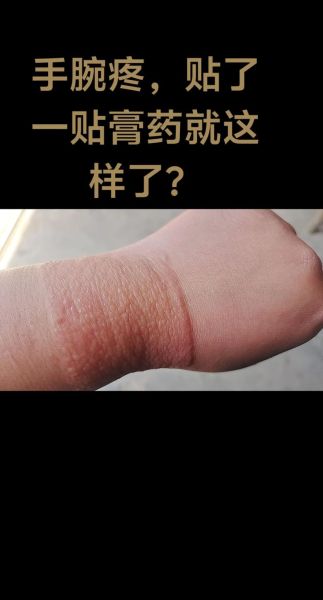 膏药贴多久换一次_膏药过敏怎么办-第3张图片-俊逸知识馆