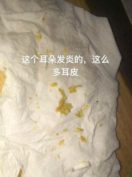 耳屎多了会怎么样_耳屎堵塞耳朵怎么办-第3张图片-俊逸知识馆