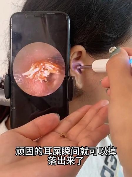 吃了耳屎会怎么样_耳屎有毒吗-第2张图片-俊逸知识馆